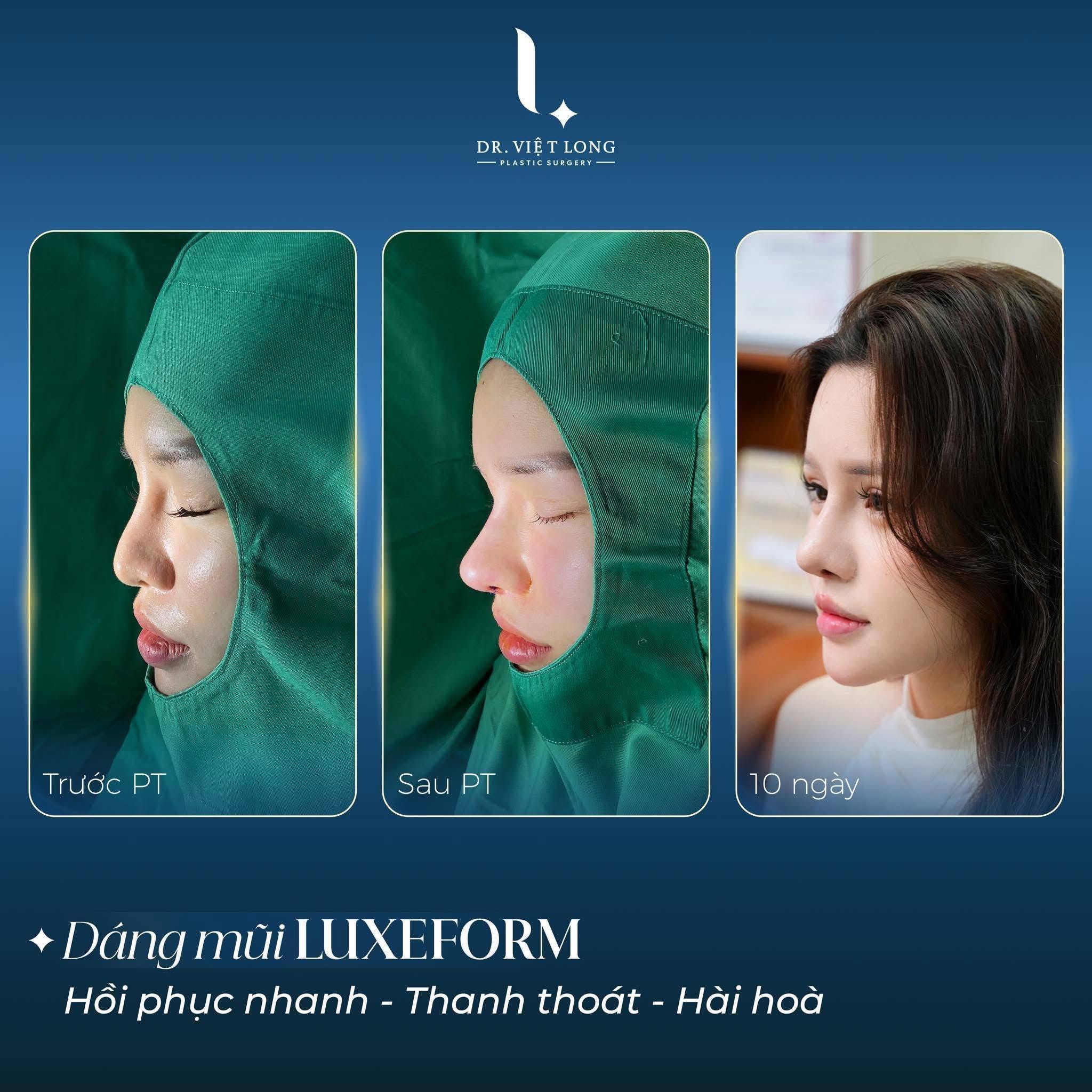 Hành trình tái sinh dáng mũi sau biến chứng