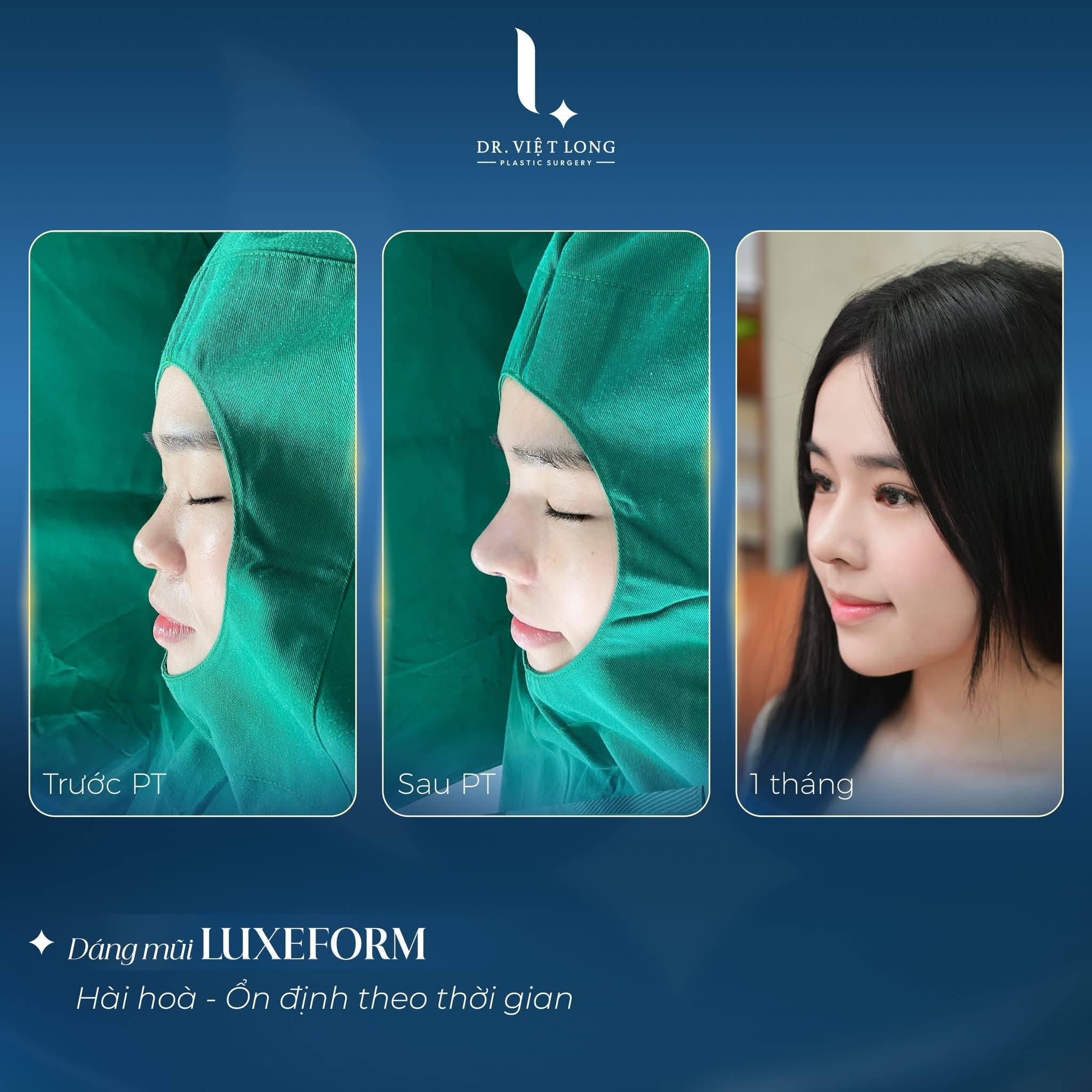Hành trình thay đổi dáng mũi của Mai Trang
