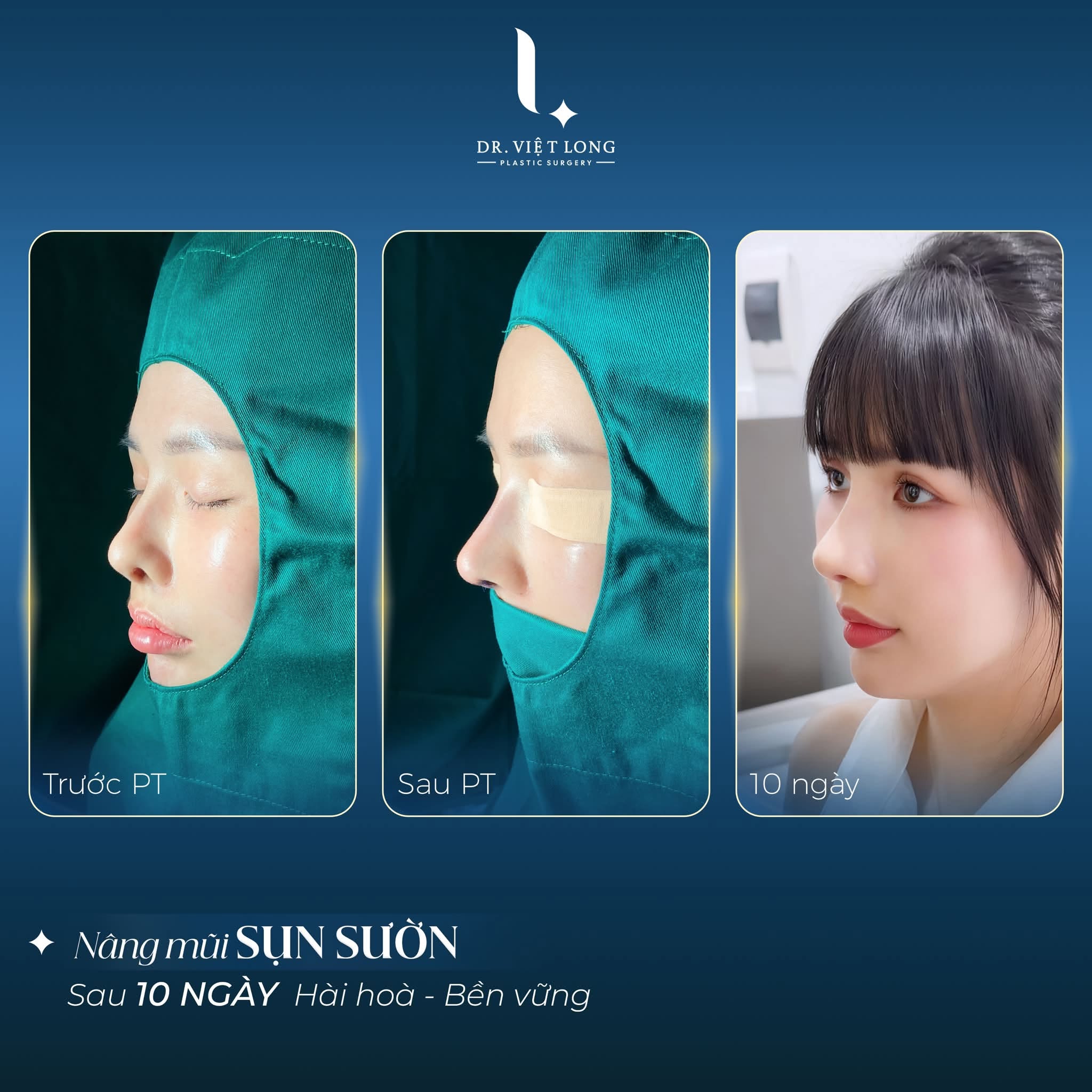 Sự ổn định theo thời gian của nâng mũi sụn sườn