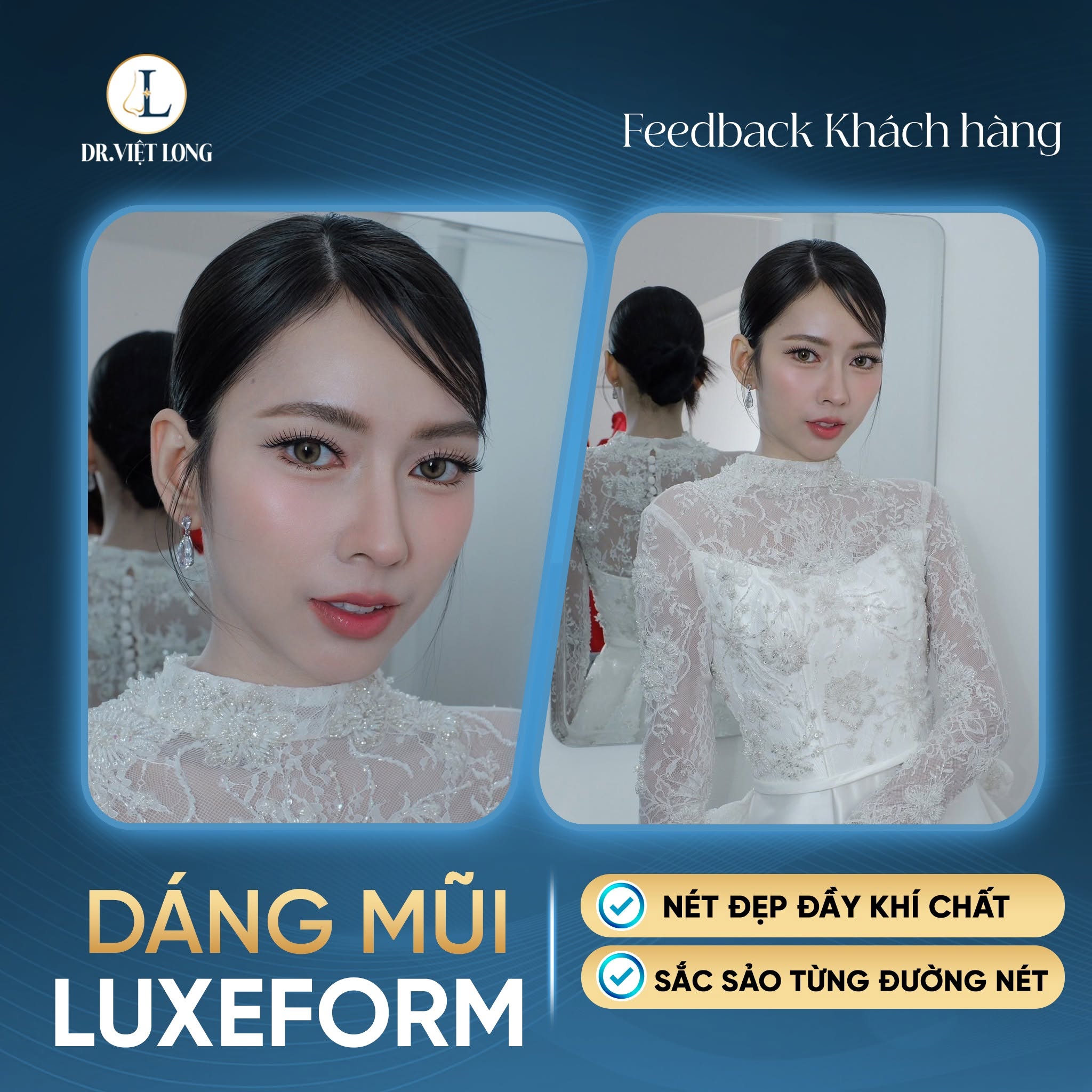 Cảm nhận sau 1 tháng cắt mí Perfect Eyes